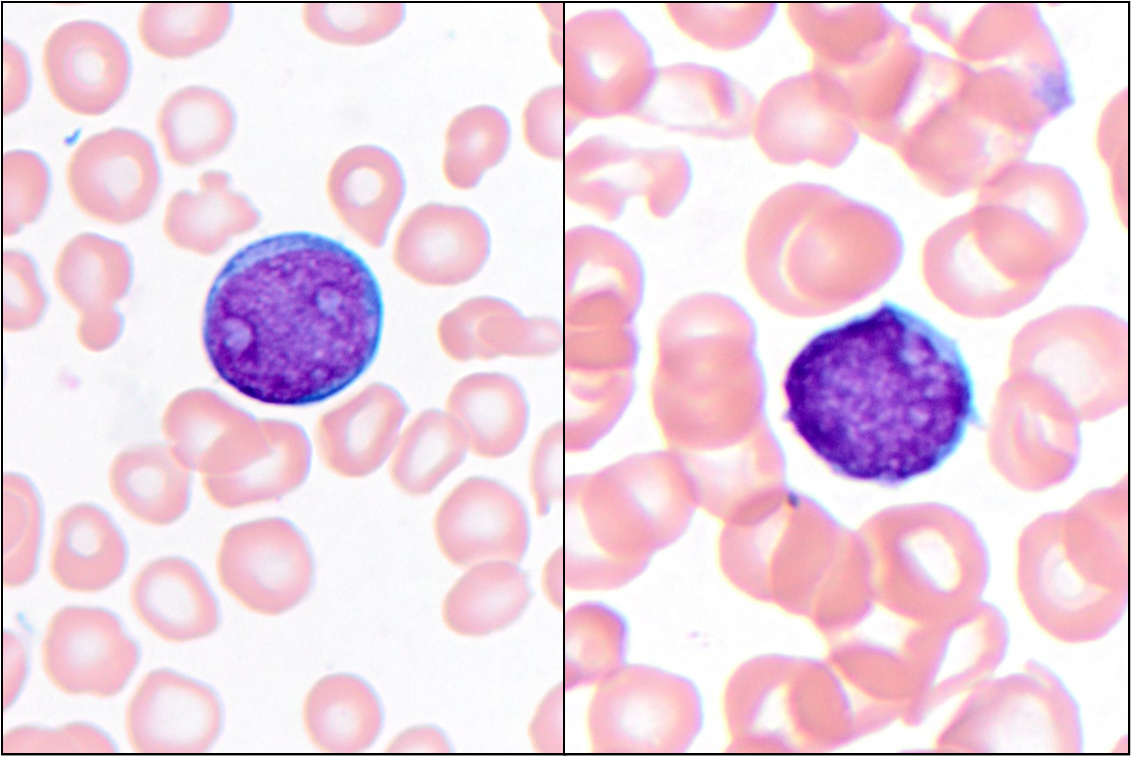 Bone marrow aspirate
